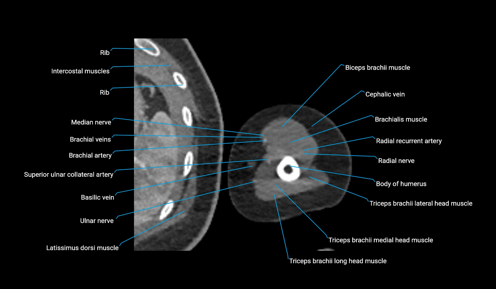 CT upper arm axial  cross sectional anatomy labelled radiology image -00304.webp
